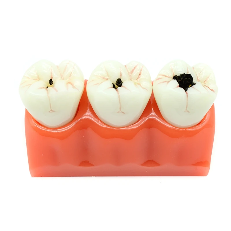 1pcs Dental Modelo de Ensino do Paciente Dissecados Cárie dentes Modelo Oral Pode ser Removido de Laboratório de prótese Dentária Modelo