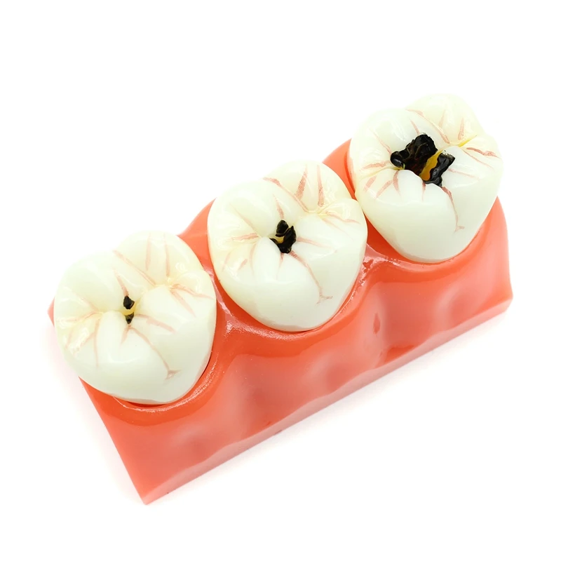 1pcs Dental Modelo de Ensino do Paciente Dissecados Cárie dentes Modelo Oral Pode ser Removido de Laboratório de prótese Dentária Modelo